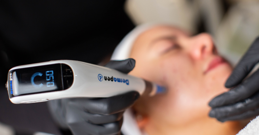 Microneedling-med-Dermapen-for-en-fastere-og-jevnere-hud 